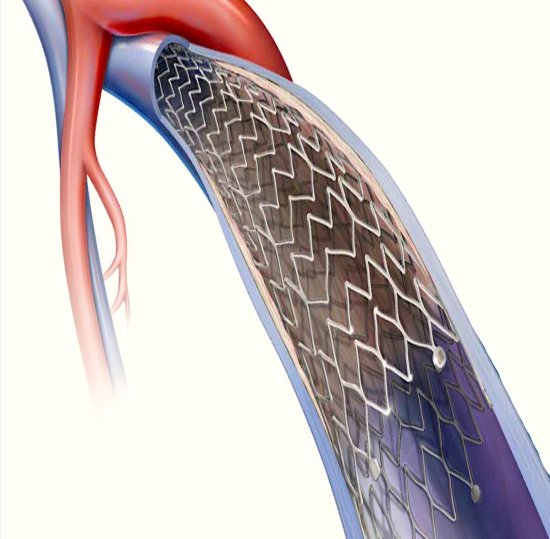Interventional Radiology Equipment